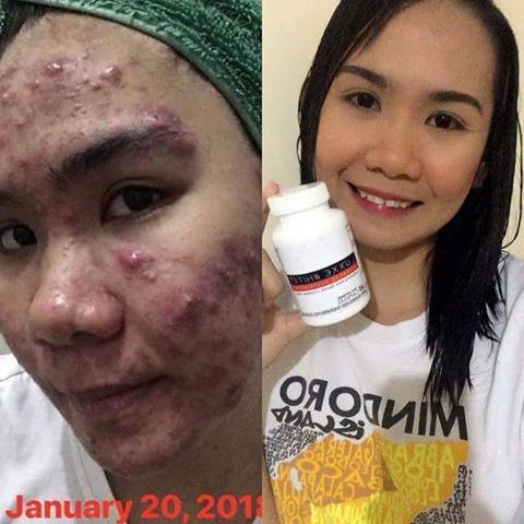 luxxe white glutathione review before and after ✓ Glutathione has to be taken daily morning empty stomach coupled with a  vit C supplement for better absorption and has to be taken for 8 months to  see a result. @truebasics_in @ main image 1