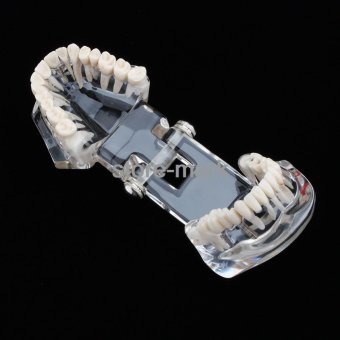 1PCS Dental Implant Disease Teeth Model With Restoration BridgeTooth Dentist For Medical Science Teaching NEW - Intl June 2018 - 5 1PCS Dental Implant Disease Teeth Model with Restoration BridgeTooth Dentist for Medical Science Teaching NEW - intl - 5
