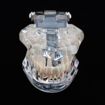 1PCS Dental Implant Disease Teeth Model With Restoration BridgeTooth Dentist For Medical Science Teaching NEW - Intl June 2018 - 3 1PCS Dental Implant Disease Teeth Model with Restoration BridgeTooth Dentist for Medical Science Teaching NEW - intl - 3