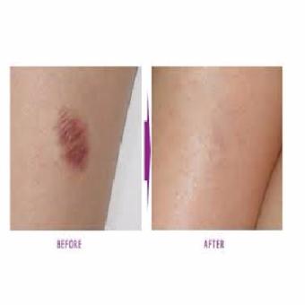 Jailev's Scar Remover Formulated Cream 10g June 2018 - 3 Jailev's Scar Remover Formulated Cream 10g - 3