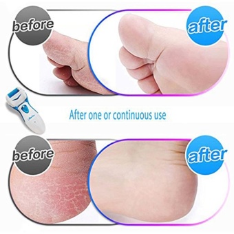 Powerful Electric Foot Callus Remover Shaver-Top Rated Electronic Foot File Removes Dry, Dead, Hard, Cracked Skin & Callous-Best Foot Care Pedicure Tool For Smooth Soft Feet-Father's Day Gift - Intl June 2018 - 2 Powerful Electric Foot Callus Remover Shaver-Top Rated Electronic Foot File Removes Dry, Dead, Hard, Cracked Skin & Callous-Best Foot Care Pedicure Tool for Smooth Soft Feet-Father's Day Gift - intl - 2