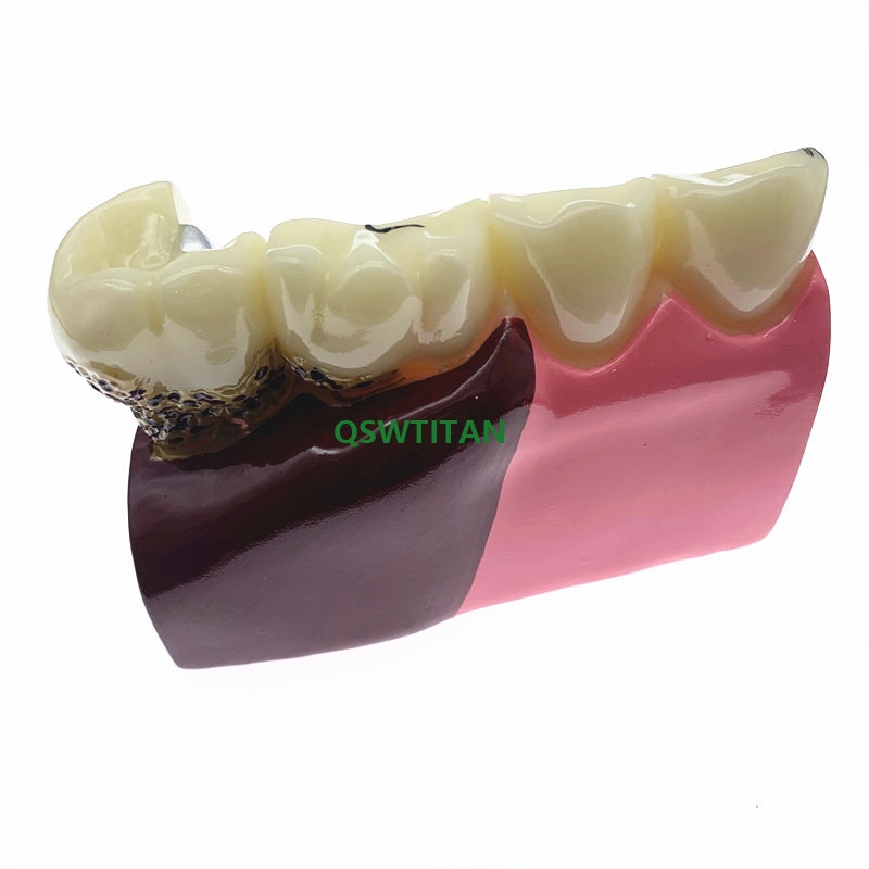 Jiayi Dental Anatomy Of Dental Caries Plastic Teeth Model Demonstration